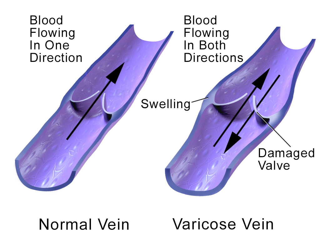 Varicose vein
compression therapy
DVT